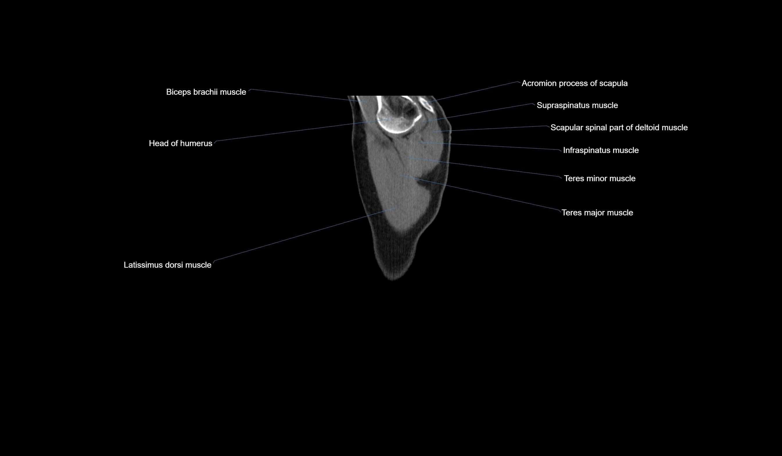 CT chest (thorax) soft tissue window labelled sagittal cross sectional anatomy radiology image-00003.webp